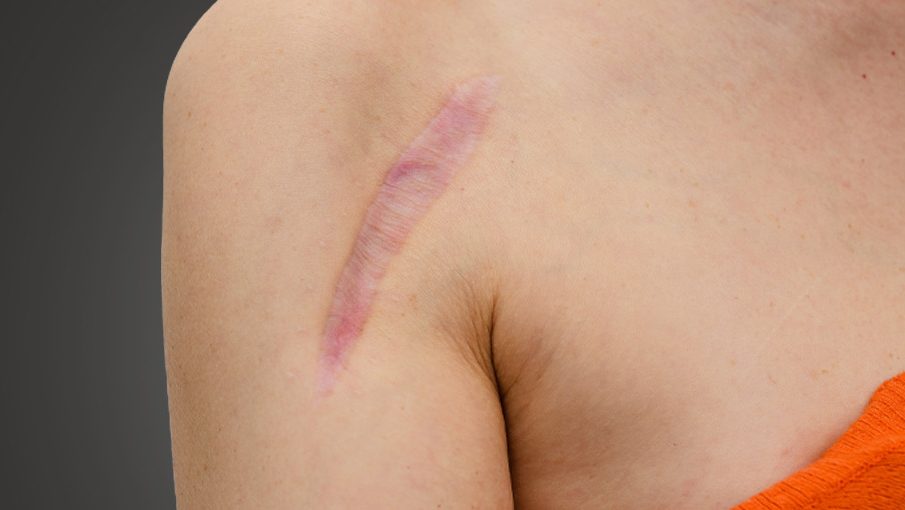Keloid Treatment