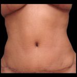 Tummy Tuck Before & After Patient #74