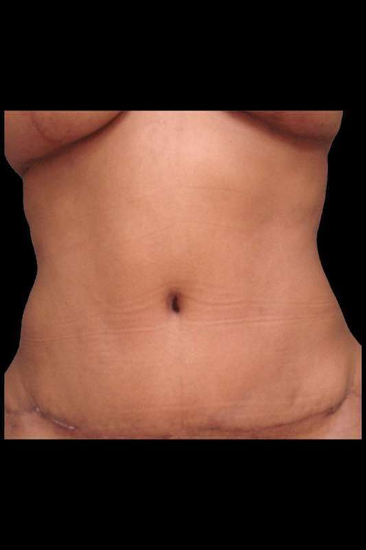 Tummy Tuck Before & After Patient #74