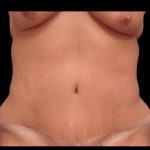 Tummy Tuck Before & After Patient #79
