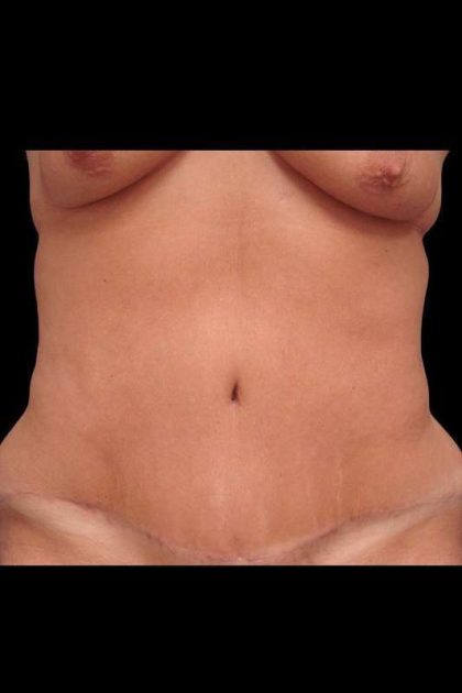 Tummy Tuck Before & After Patient #79