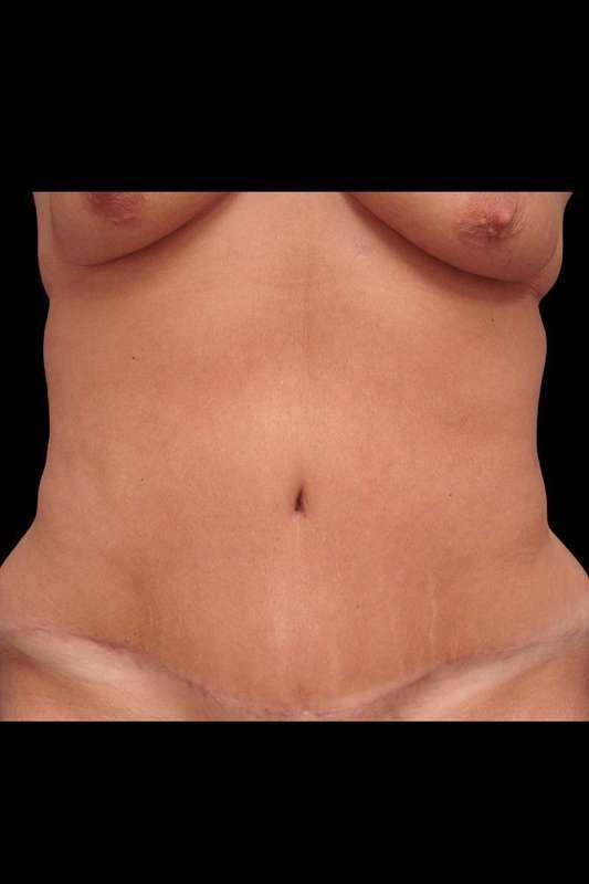 Tummy Tuck Before & After Patient #79