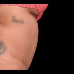 Tummy Tuck Before & After Patient #69