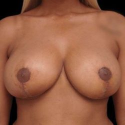 Breast Reduction Before & After Patient #94