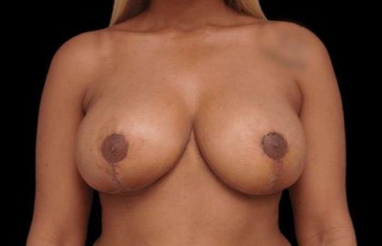Breast Reduction Before & After Patient #94