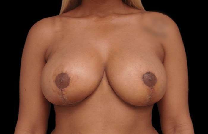 Breast Reduction with Lift Before & After Patient #94