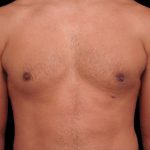 Gynecomastia Before & After Patient #101