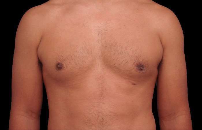 Gynecomastia Before & After Patient #101