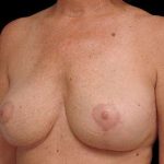 Breast Lift Before & After Patient #108