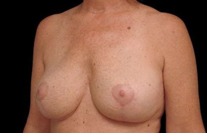 Breast Lift Before & After Patient #108