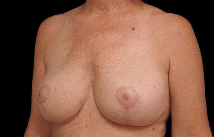 Breast Implant Removal Before & After Patient #108