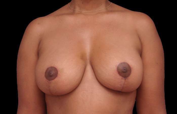 Breast Lift Before & After Patient #115