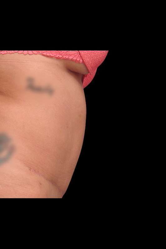 Tummy Tuck Before & After Patient #69