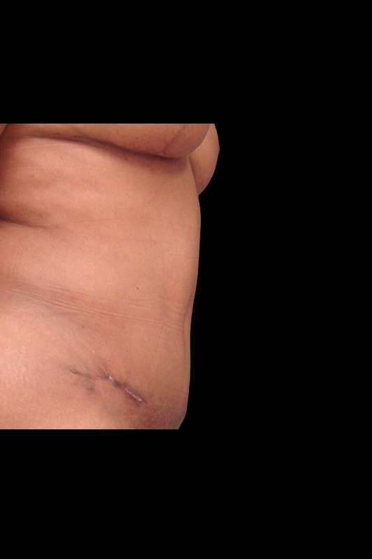 Tummy Tuck Before & After Patient #74