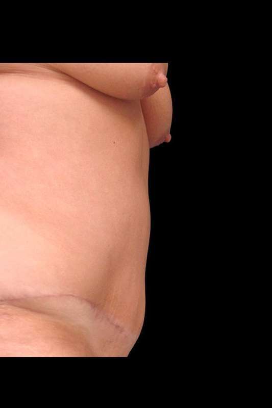 Tummy Tuck Before & After Patient #79