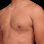 Gynecomastia Before & After Patient #101