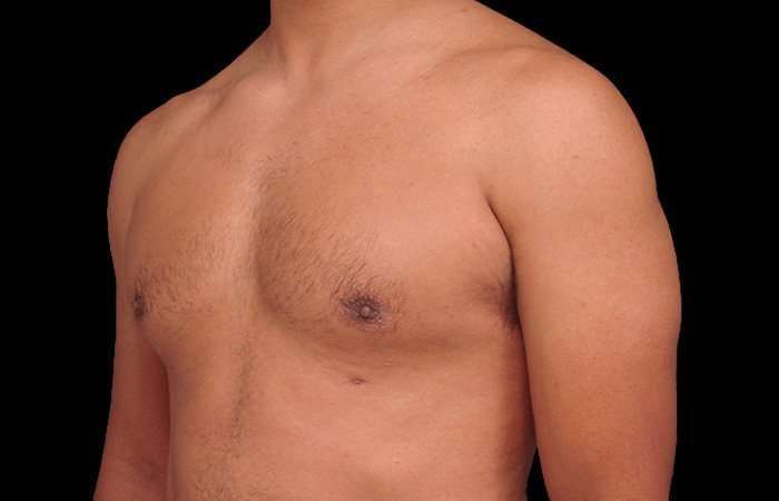 Gynecomastia Before & After Patient #101
