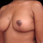 Breast Lift Before & After Patient #115