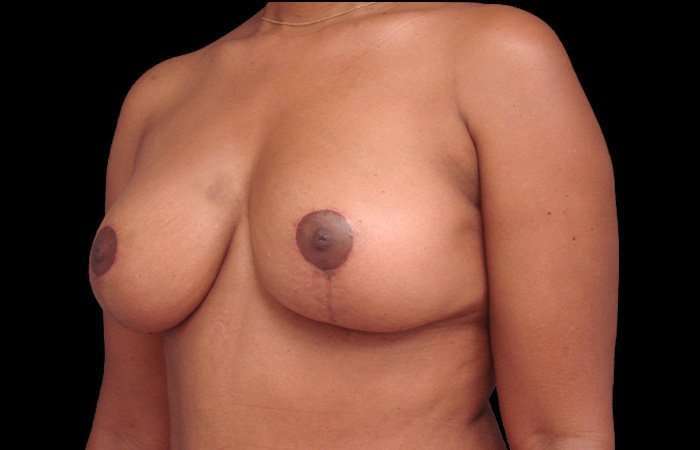 Breast Lift Before & After Patient #115