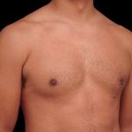 Gynecomastia Before & After Patient #101