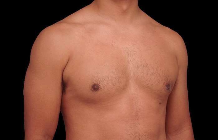 Gynecomastia Before & After Patient #101