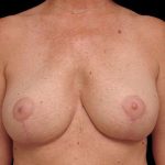 Breast Lift Before & After Patient #108