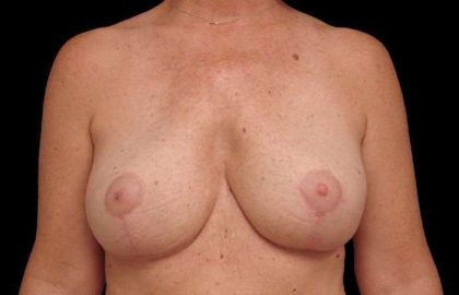 Breast Lift Before & After Patient #108