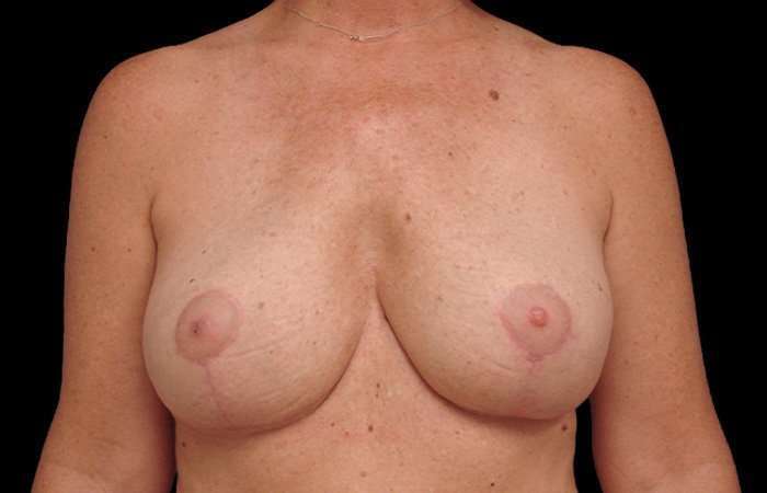 Breast Implant Removal Before & After Patient #108