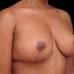 Breast Lift Before & After Patient #115