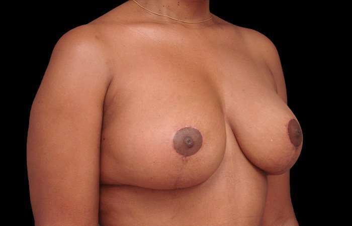 Breast Lift Before & After Patient #115