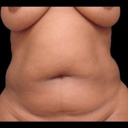 Tummy Tuck Before & After Patient #74