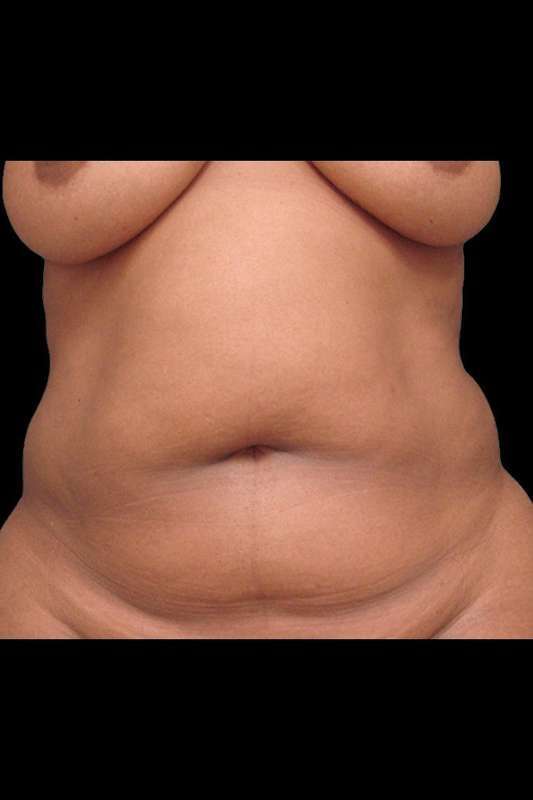 Tummy Tuck Before & After Patient #74