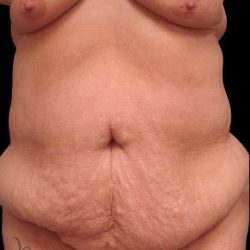 Tummy Tuck Before & After Patient #79