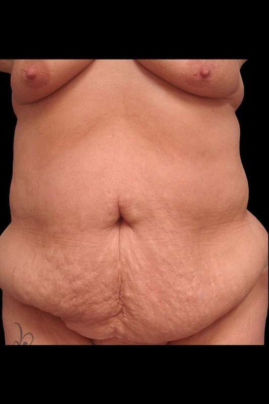 Tummy Tuck Before & After Patient #79