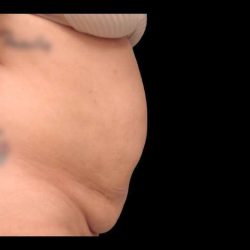 Tummy Tuck Before & After Patient #69