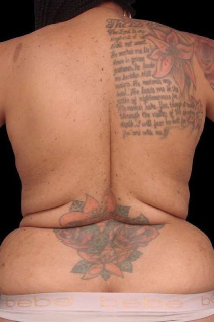 Bra Line Lift Before & After Patient #82