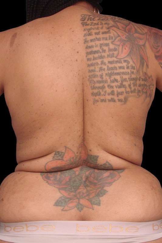 Bra Line Lift Before & After Patient #82