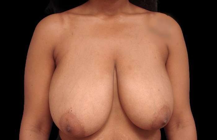 Breast Reduction with Lift Before & After Patient #94