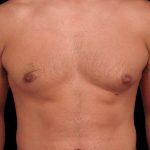 Gynecomastia Before & After Patient #101