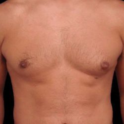 Gynecomastia Before & After Patient #101