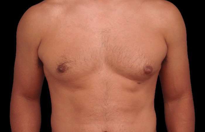 Gynecomastia Before & After Patient #101