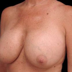 Breast Lift Before & After Patient #108