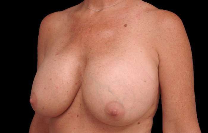 Breast Implant Removal Before & After Patient #108