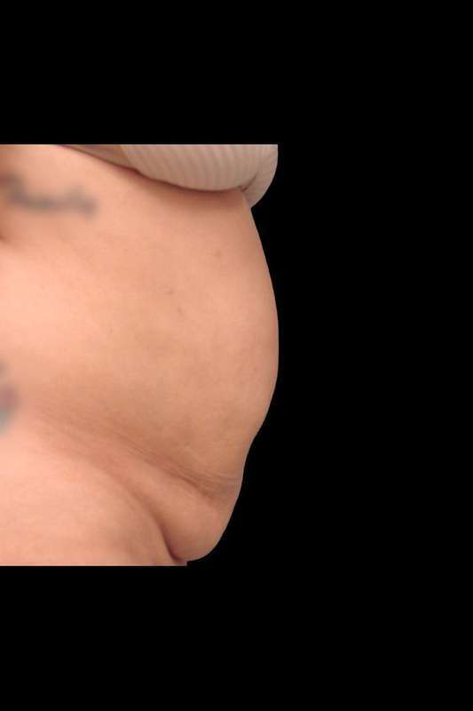 Tummy Tuck Before & After Patient #69