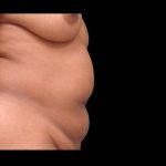 Tummy Tuck Before & After Patient #74