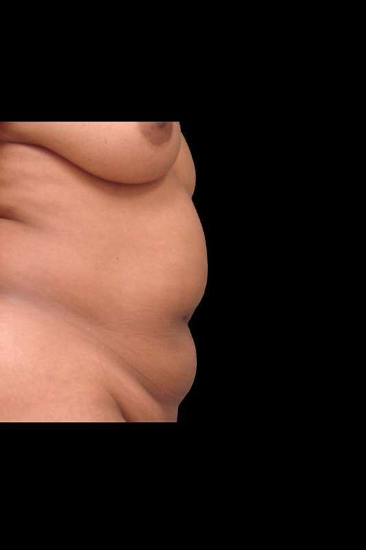 Tummy Tuck Before & After Patient #74