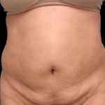 Tummy Tuck Before & After Patient #69
