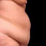 Tummy Tuck Before & After Patient #79