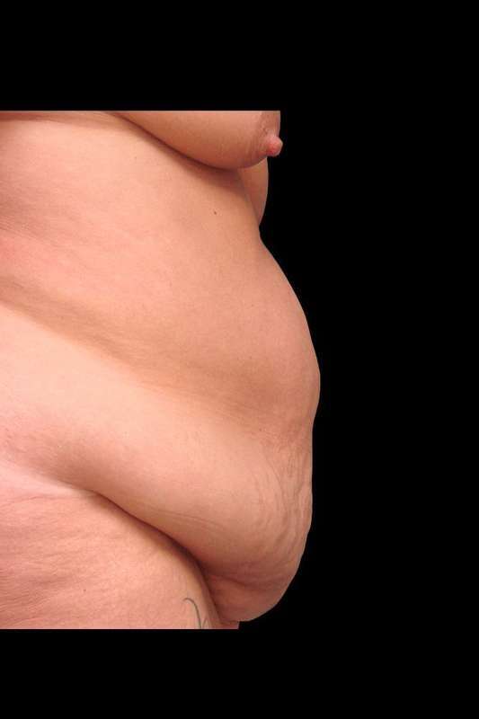 Tummy Tuck Before & After Patient #79