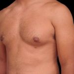 Gynecomastia Before & After Patient #101